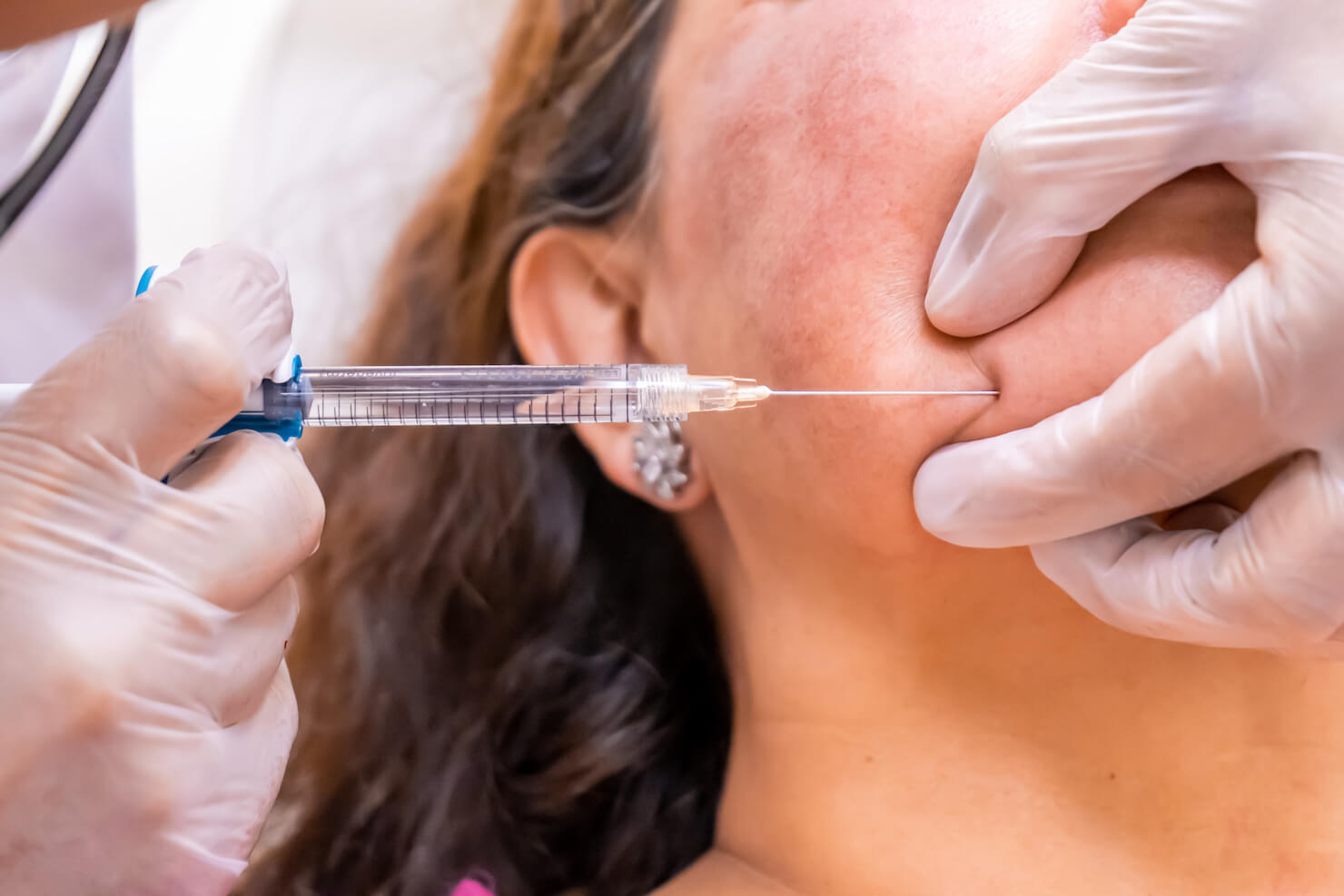Surrey jawline contour with dermal filler using md codes method for soft lift procedure