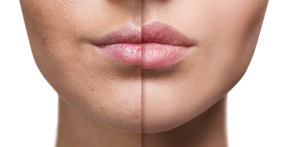 thin lips before and after lip augmentation