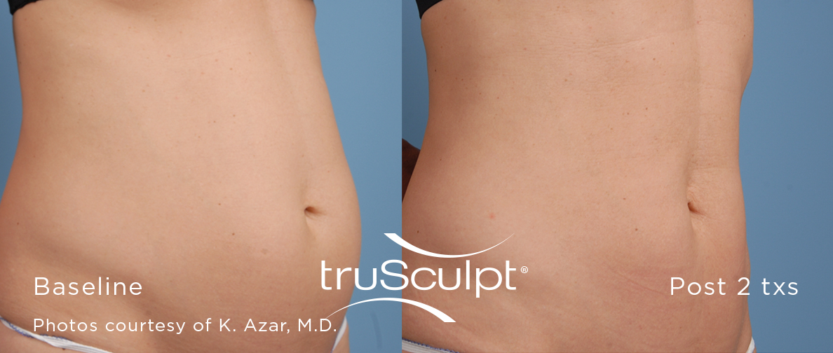 Before and after trusculpt before and after fat removal