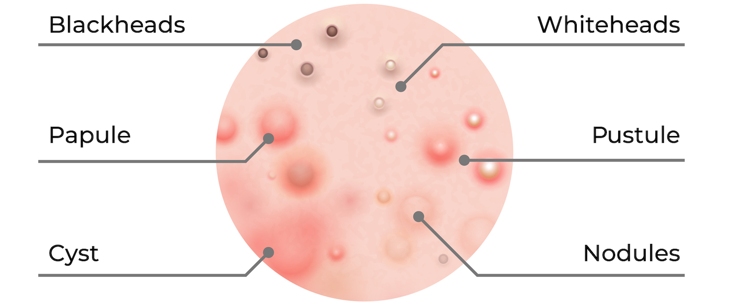 types of acne diagram for Surrey acne solutions page