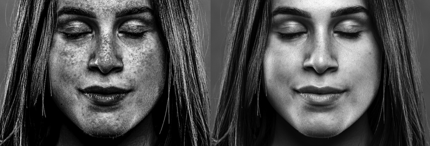 UV photography showing sun damage under visible skin with freckles