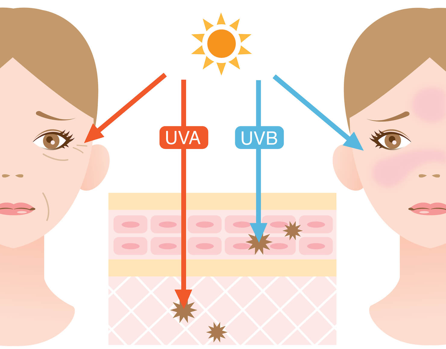 UVA and UVB penetration into skin causing visible burns and signs of aging diagram explanation