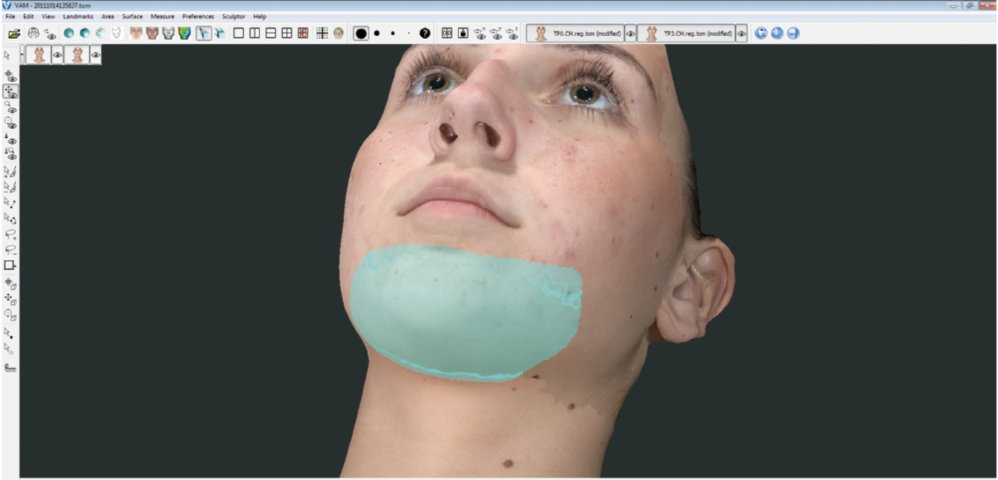 Vectra 3D chin selector modification tool simulation