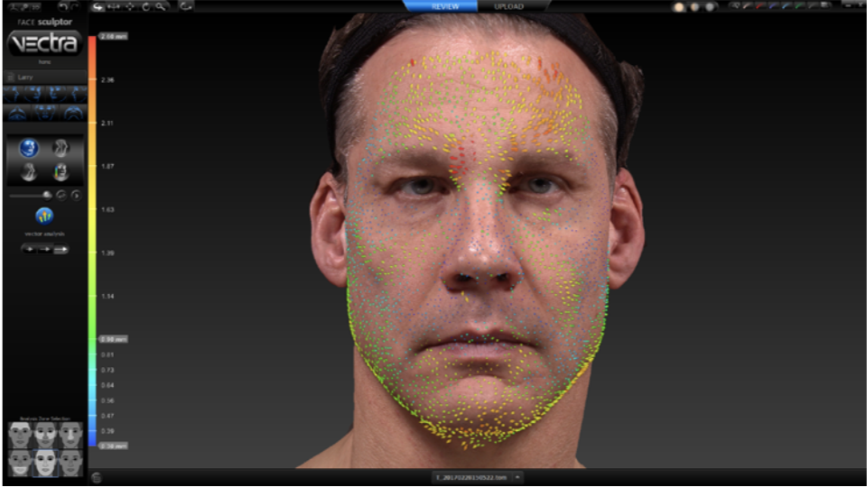digital face markers on the Vectra 3d imaging system