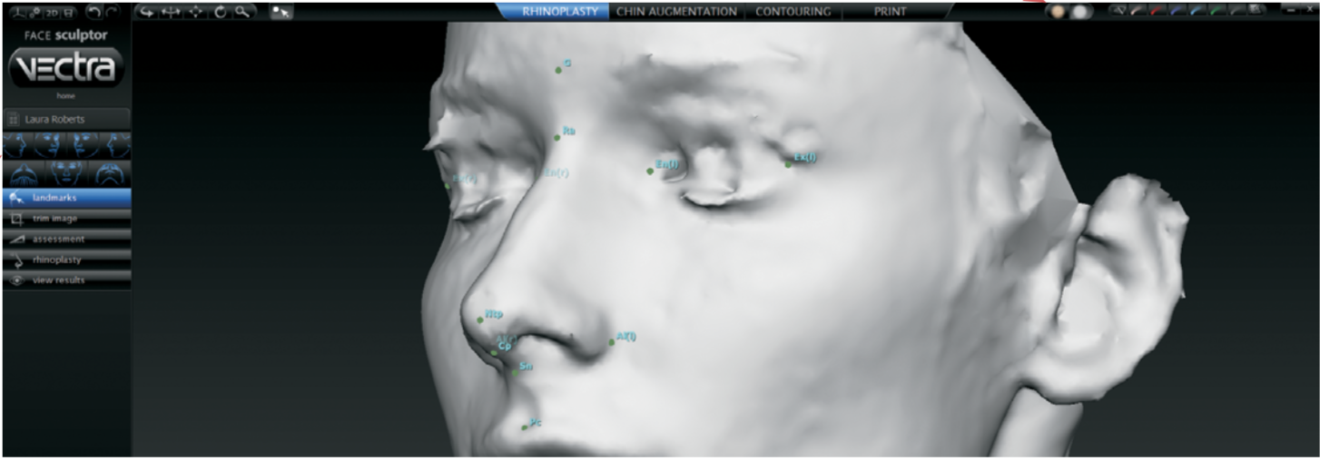 Vectra 3D gray mode to show face model without colour or shadows for structure changes with beauty treatments