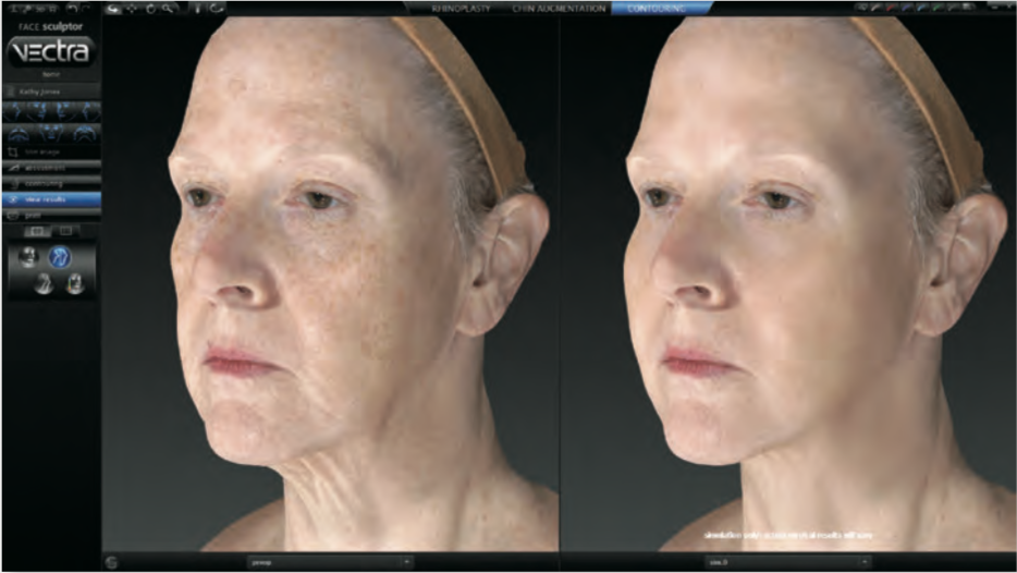 smooth wrinkles simulator on Vectra 3D computer software