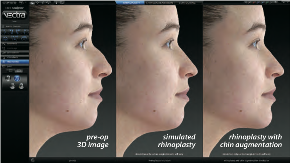 Vectra 3d nose shape simulator with face sculptor feature