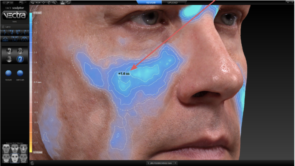 volume face maps example screen on the Vectra 3D imaging system