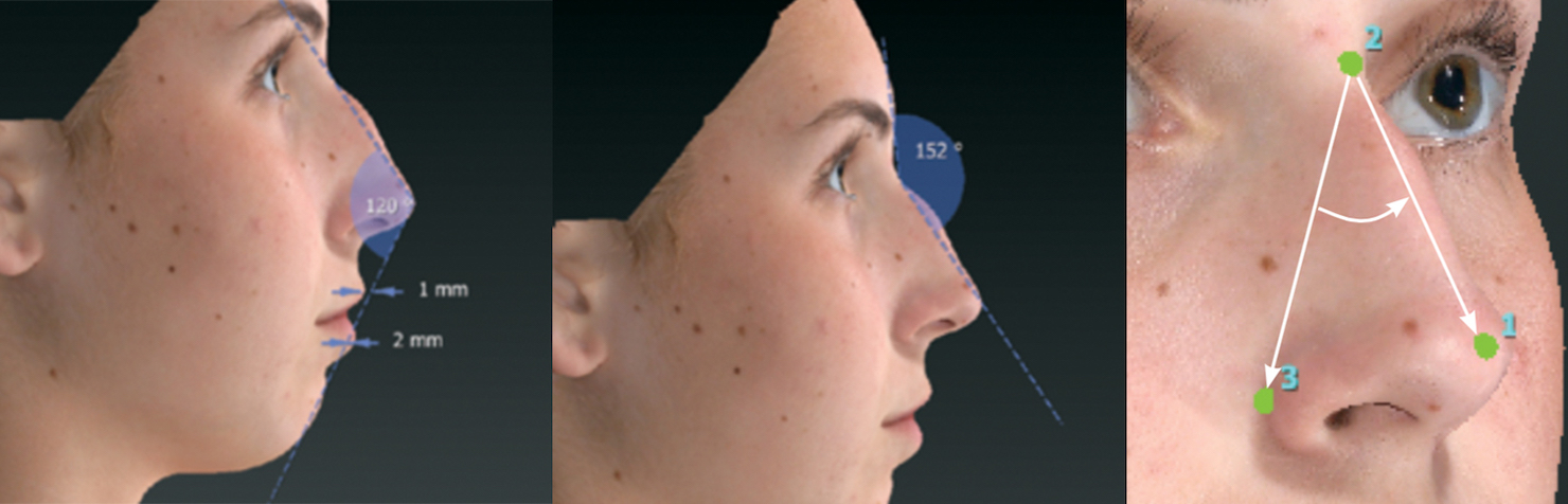 Vectra 3D nose shape degrees marker measurements example