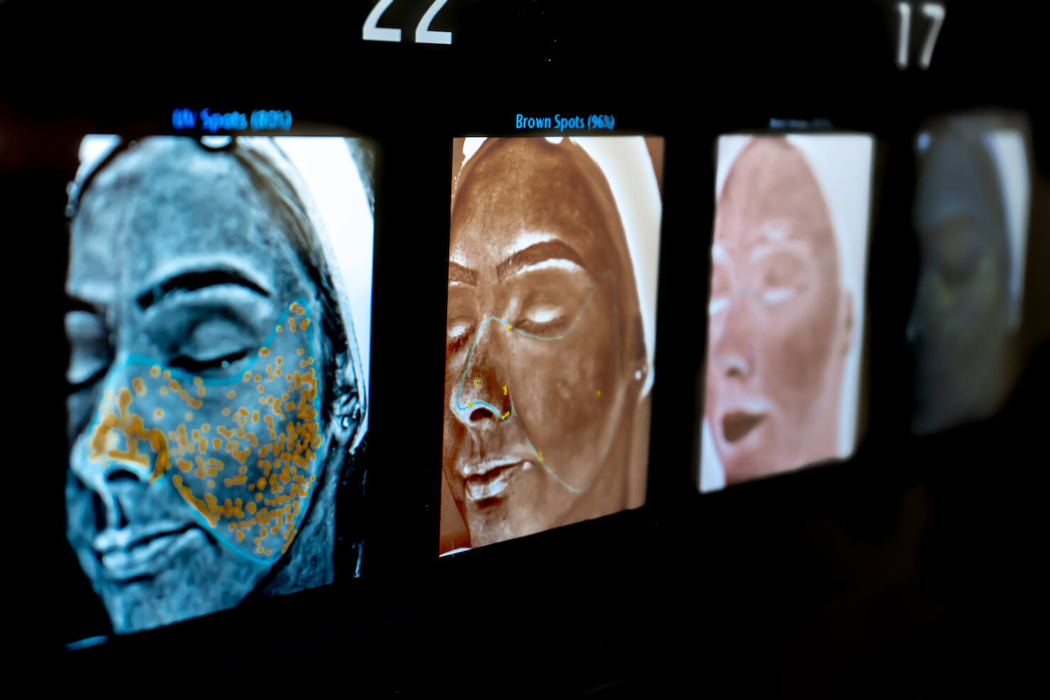 visia complexion scan showing sun damage and face scans with brown spots and uv spots