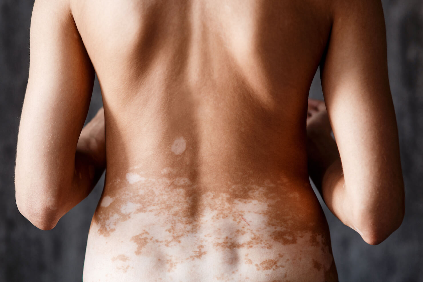 Vitiligo hypopigmentation on female back skin
