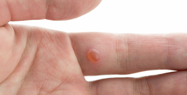 wart bump on finger on inside of hand